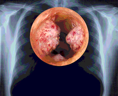 Lung Tumour Ribcage