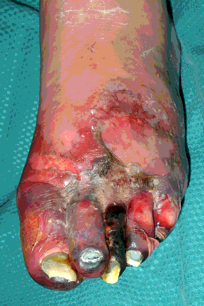 2011-5-gangrene