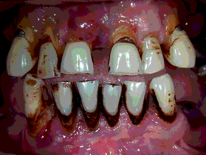 2011-8- teeth male